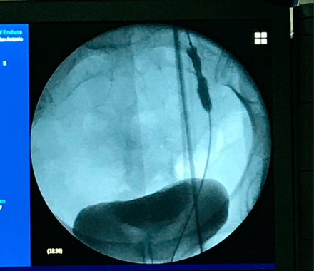 Imagen del implante endoureteral realizado por Vithas Málaga.